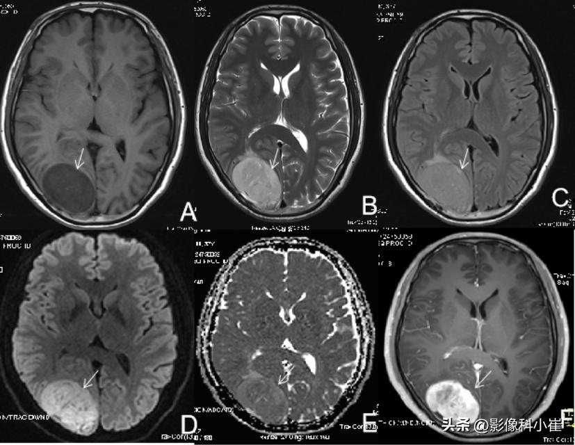 经典医学影像4.6——脑膜瘤