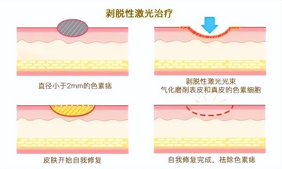 谈痣色变,身上长的痣都是色素痣吗