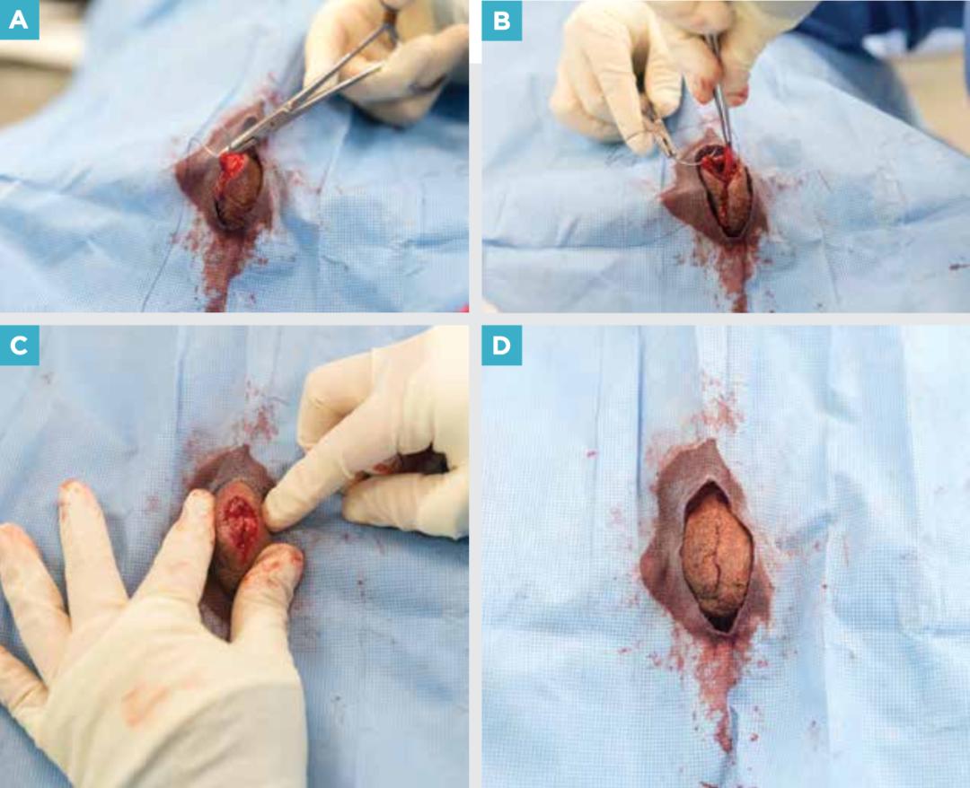 附睾炎切除术多少钱,附睾炎微创手术治疗全过程