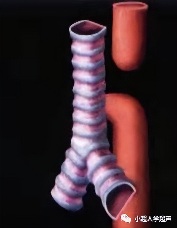 超声影像小视频,食道闭锁超声表现