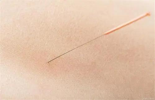 头部脑供血不足穴位,头部穴位针灸的作用