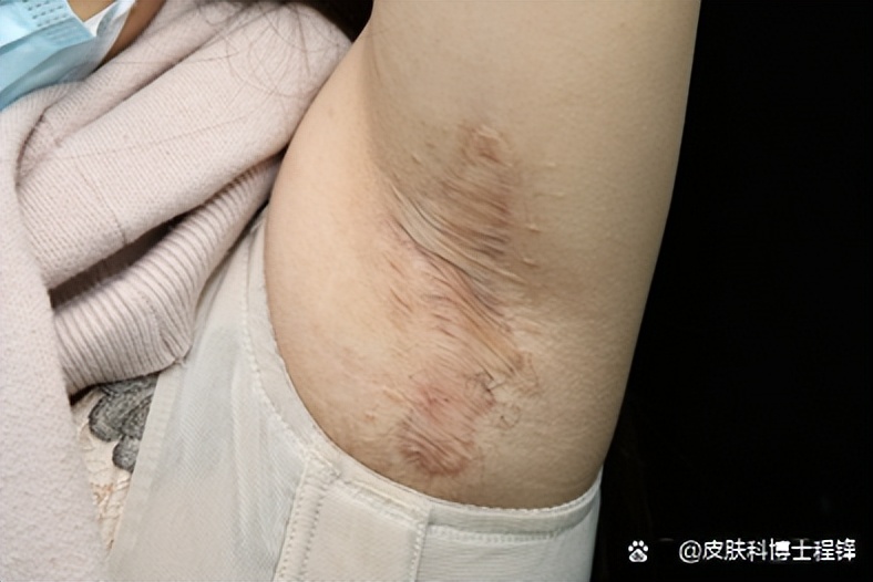 做完腋臭微创手术复发几率,腋臭手术后复发了怎么调理排毒