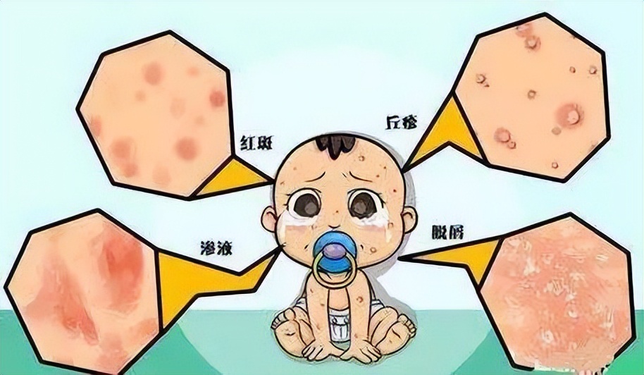 肛周湿疹瘙痒可以用炉甘石吗,肛周瘙痒怎么判断是痔疮还是湿疹