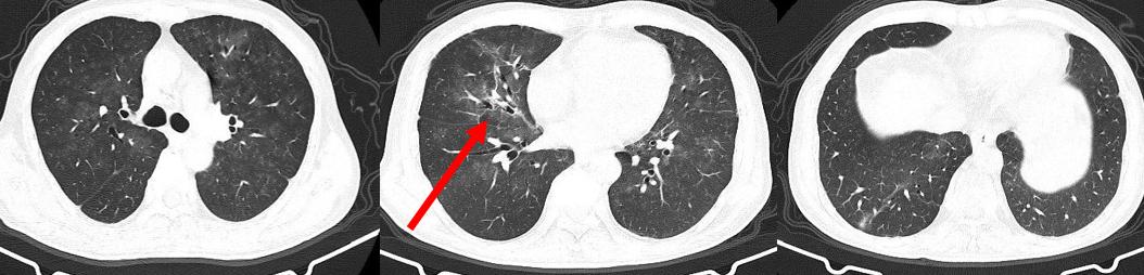 如何解读mNGS阴性结果？何时可能出现假阴性？真阴性又是为何？