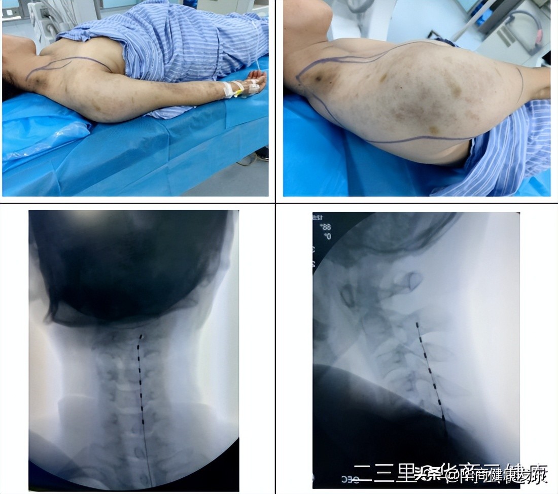 疱疹神经痛科普视频,带状疱疹疼痛处理专家共识