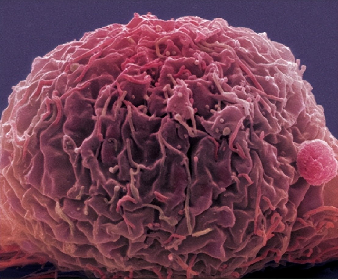 女子腰椎间盘突出,女性腰痛和腰椎间盘突出