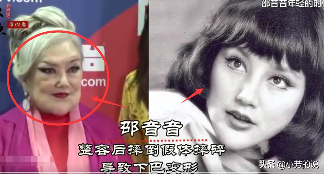 整容后出车祸假体外露,整容了被砸到脸会怎么样