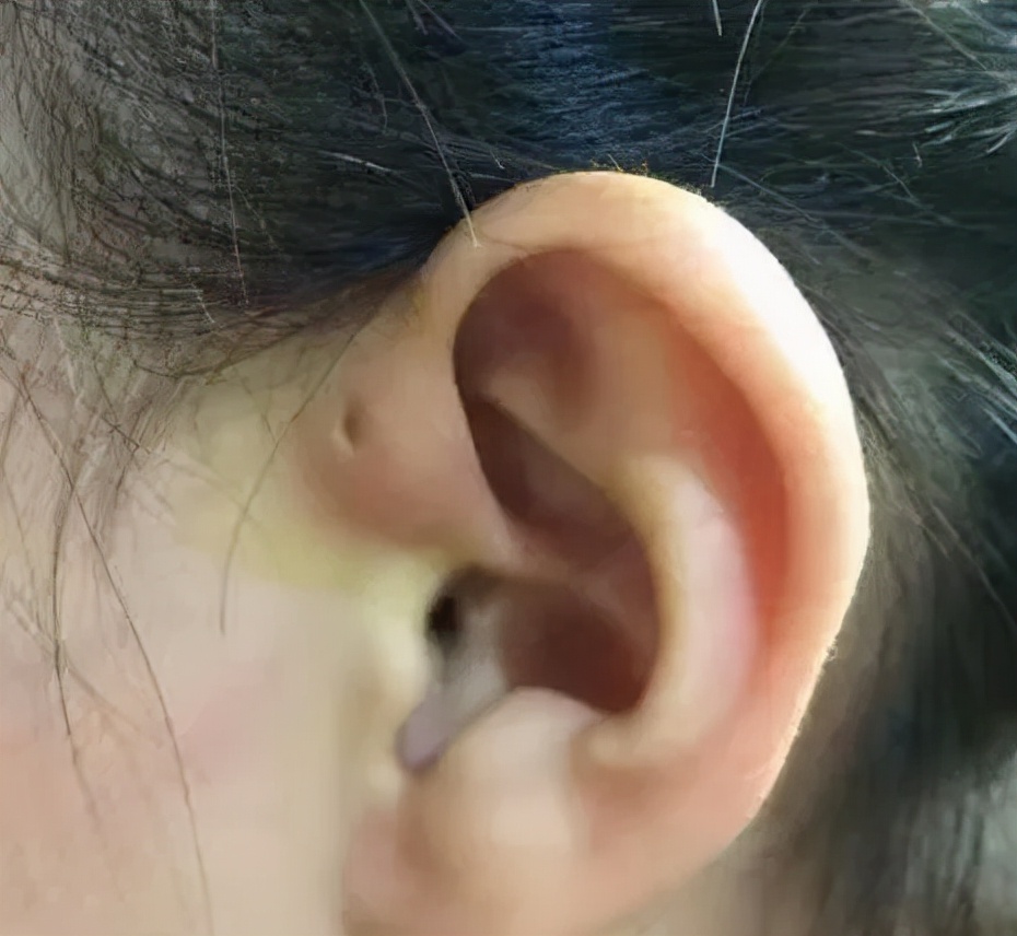 恶性肿瘤造瘘,癌症造瘘是什么意思