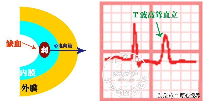护考几种常见的心电图,常见的心电图图形分析