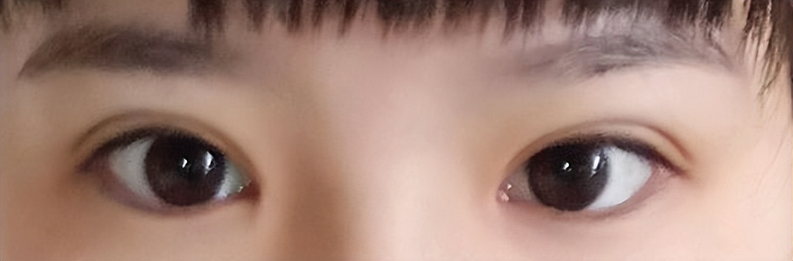 太原丽都整形医院双眼皮,太原双眼皮修复大概需要多少钱