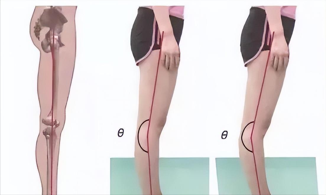 偏瘫肘关节伸不直怎样康复,偏瘫膝过伸走路不能屈膝怎么办