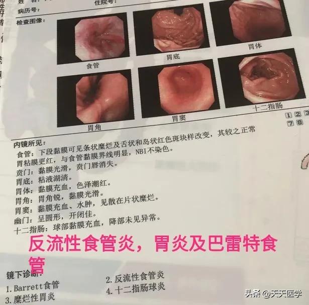 有胃病的人多久做一次胃镜检查,做胃镜是针对哪些胃病的检测手段