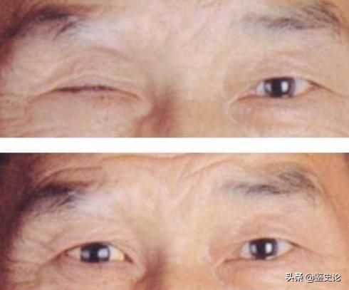 87岁老太右眼被打瞎,四川老太儿时射瞎双眼