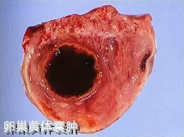 超声显示子宫肌瘤卵巢囊肿,显微镜下的卵巢囊肿