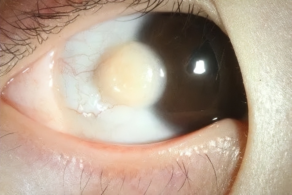 眼底有颗黄豆大小的瘤子可怕吗,眼睛里有一块褐色的斑块图片