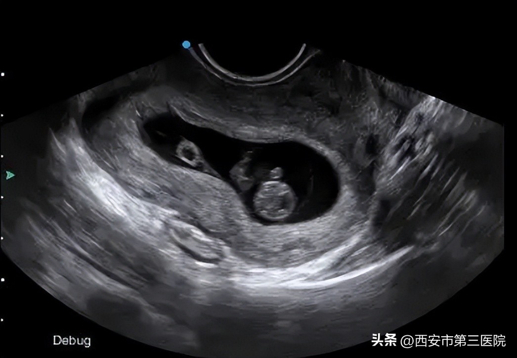 走出误区｜早孕能做阴超吗？