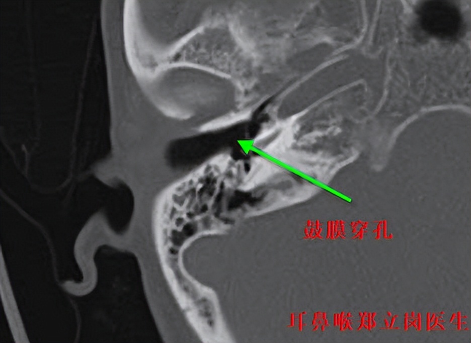 中耳炎为什么要做鼻中隔手术,中耳炎为什么要做手术