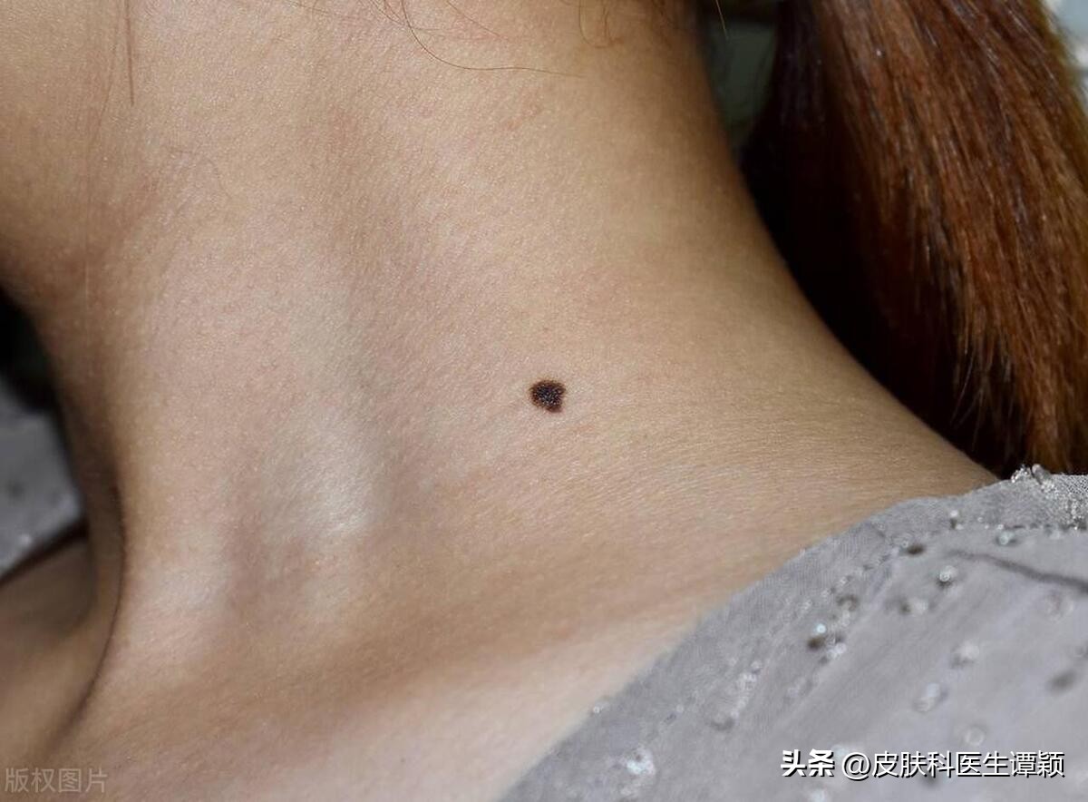 医院皮肤科医生谈痣,皮肤科色素痣科普