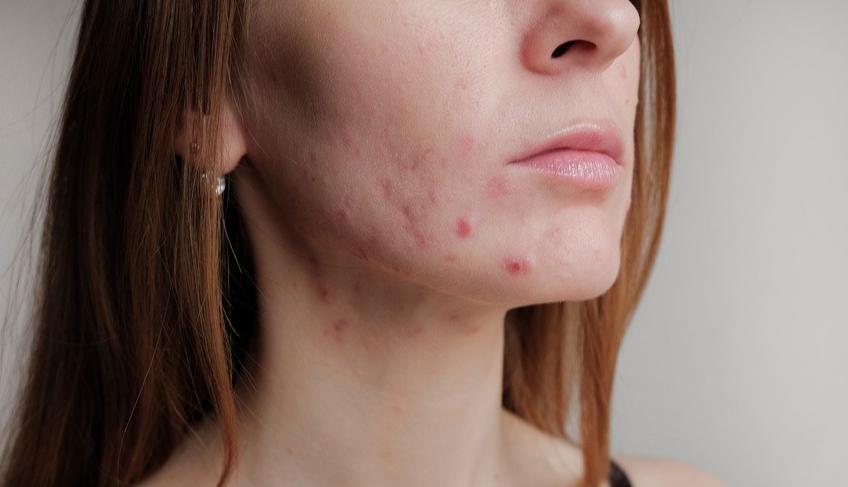 春敏脸上泛红发痒原因,春敏肌屏障修复