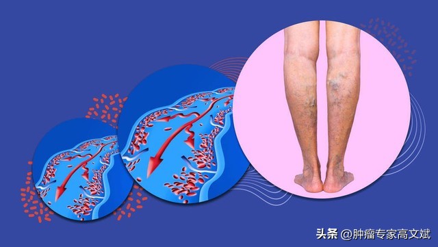 肿瘤病人血栓与什么有关,与肿瘤发生的有关因素有哪些