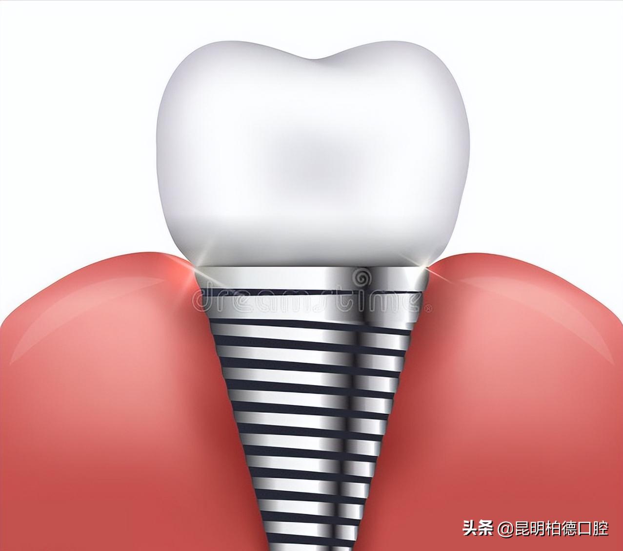 牙齿缺了10年现在还可以种植牙吗,满牙齿都烂了怎么才能种植牙
