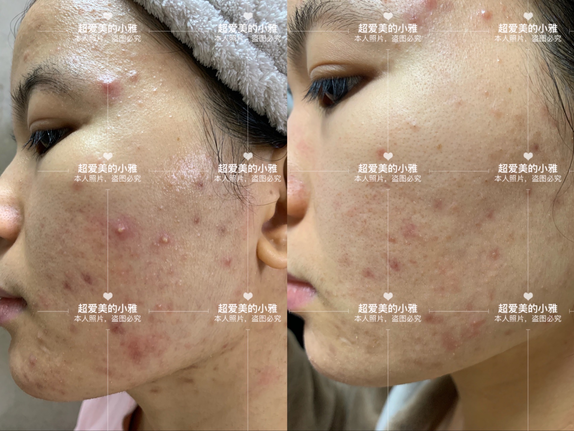 战胜痘痘重拾自信,对抗痘痘常用药膏