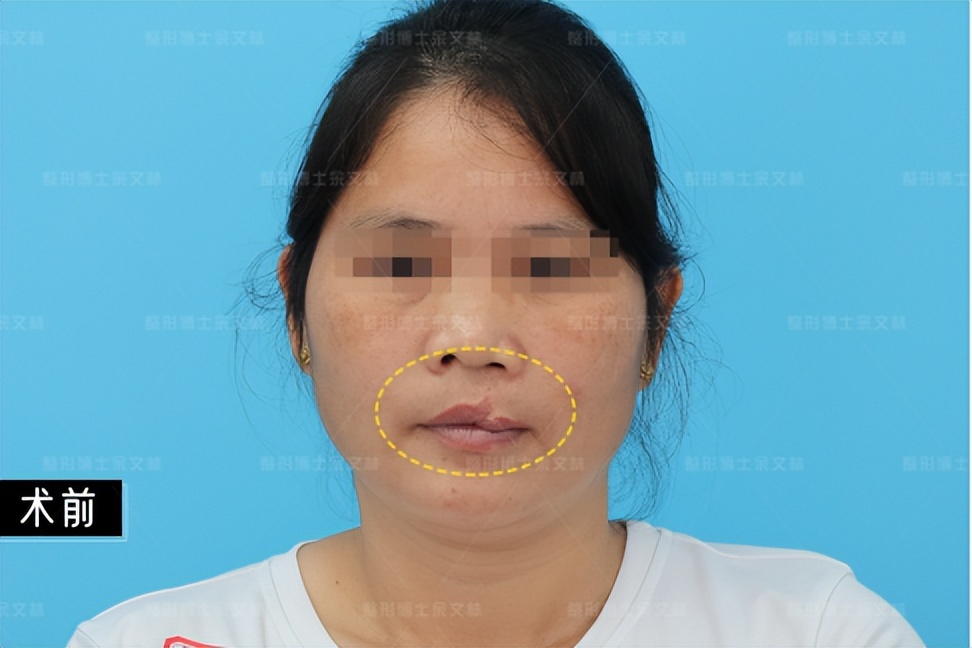 天生歪脖可以矫正吗,天生歪嘴能治好吗成人