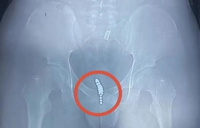 浙江14岁男孩体内取出19颗磁力珠,浙江14岁男孩体内取出30颗磁力珠