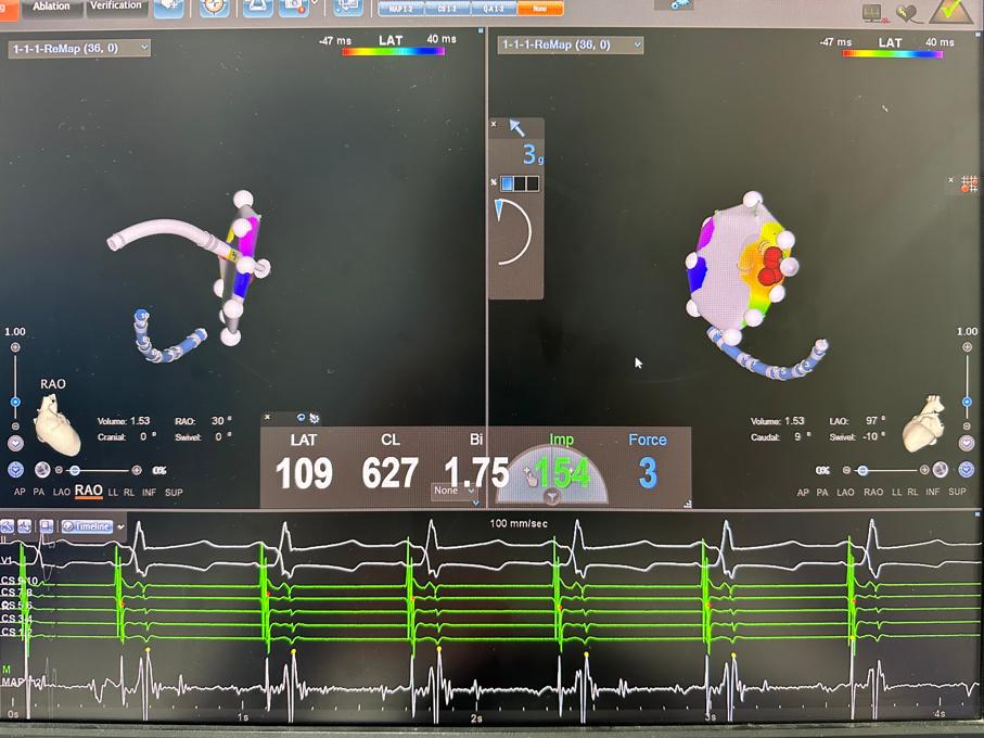 【一院技术】6岁儿童突发室上性心动过速！济宁市第一人民医院儿科、心内科成功开展射频消融术