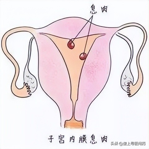 绝经十几年了出现囊肿,绝经后卵巢肿物是怎么回事