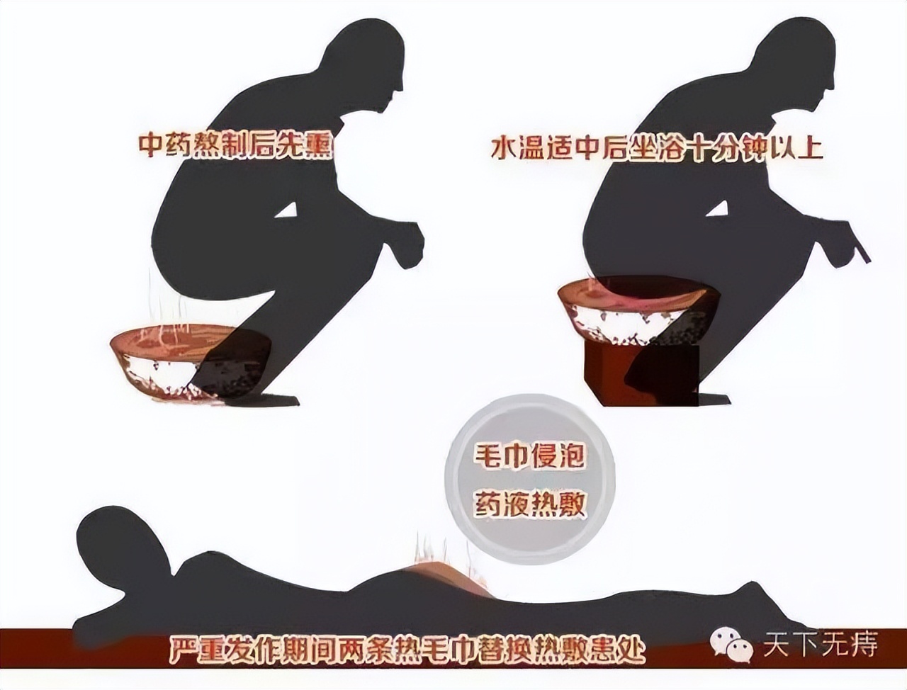 中药熏蒸浴步骤,中药熏洗坐浴操作视频