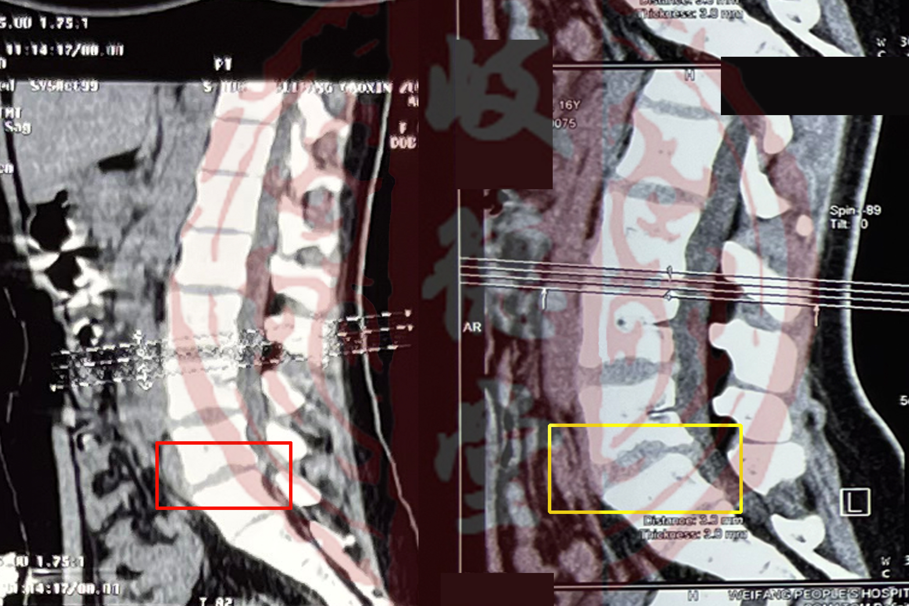 【案例分享】16岁腰椎滑脱患者的康复案例