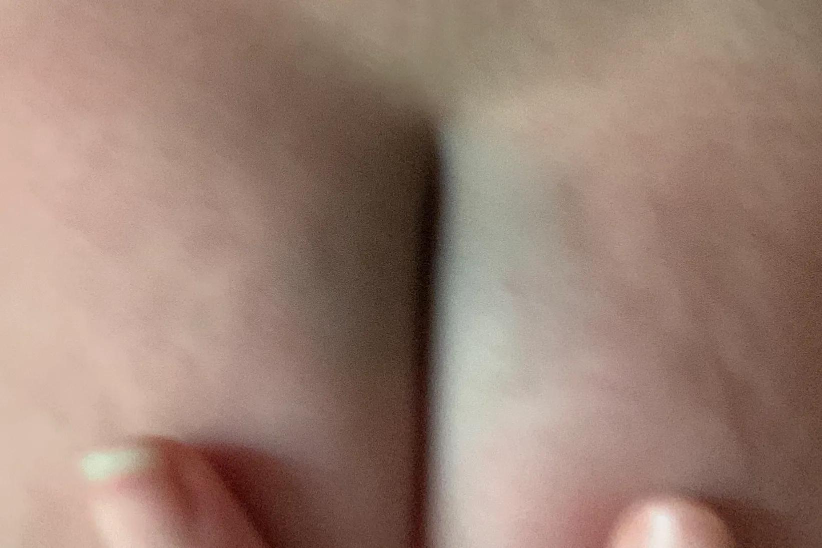 我家宝宝手上有胎记,宝宝身上有个胎记模糊不清