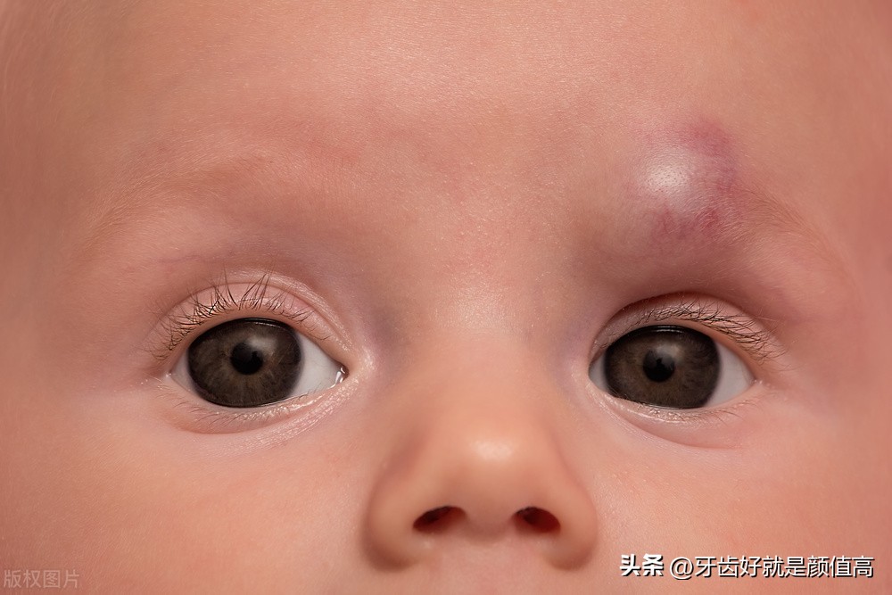 嘴唇血管瘤脸部麻木,妈妈血管瘤7公分左右怎么办