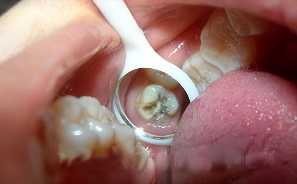 小小的蛀牙怎么办,蛀牙洞很小到底要不要补