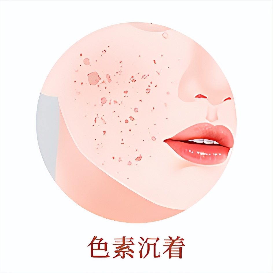 褐斑老年斑怎么治疗效果最好,老年斑褐斑消除最好的方法