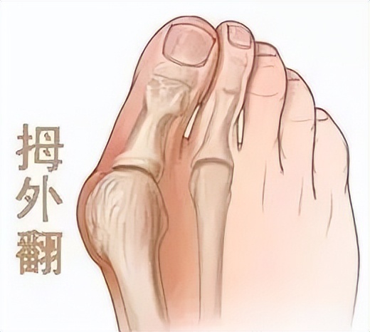 拇趾外翻注意事项,拇外翻要注意哪些事项