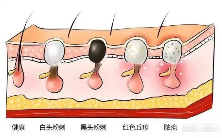 脸上长黑头粉刺什么原因,脸上长粉刺的原因和解决方法