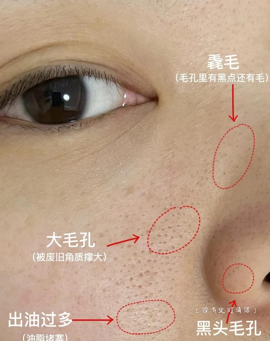 几款解决毛孔粗大的实用方法,毛孔粗大全搞定这些知识要牢记