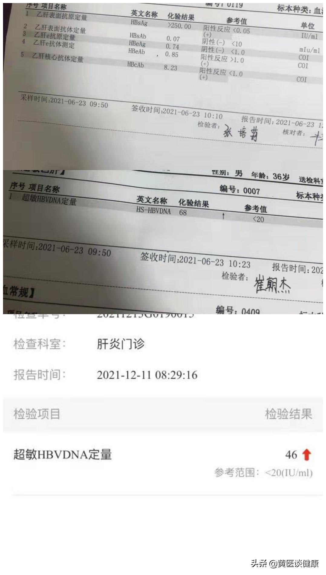 乙肝小三阳门静脉增宽16能活多久,抗病毒1年反而肝纤维化严重了
