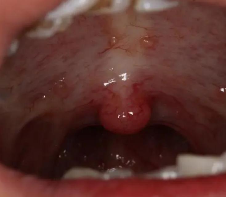 怎么快速缓解口腔溃疡的痛苦,嘴里长口腔溃疡怎么治好得快