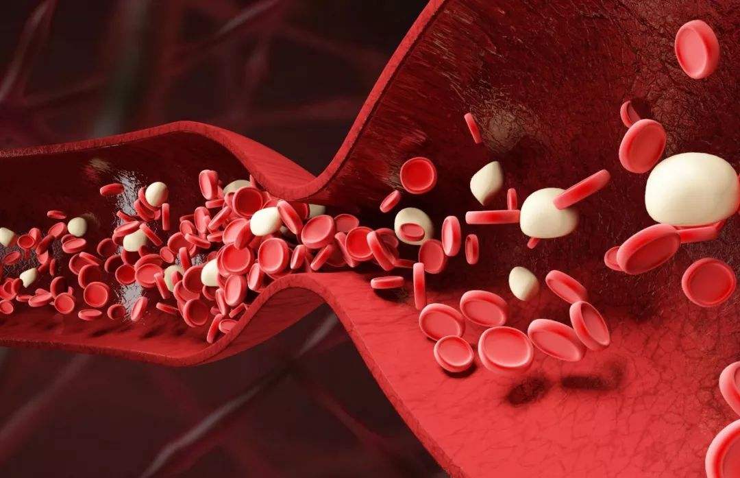 血瘀痰湿高血压能治好吗,血瘀型高血压的经典方子