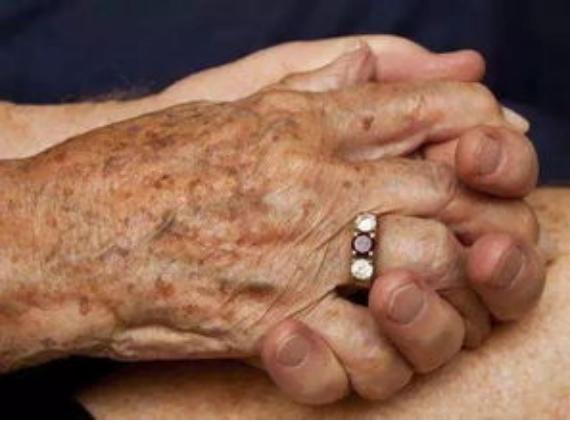 老年斑脂溢性角化病的最佳治疗,脂溢性角化老年斑激光后的护理