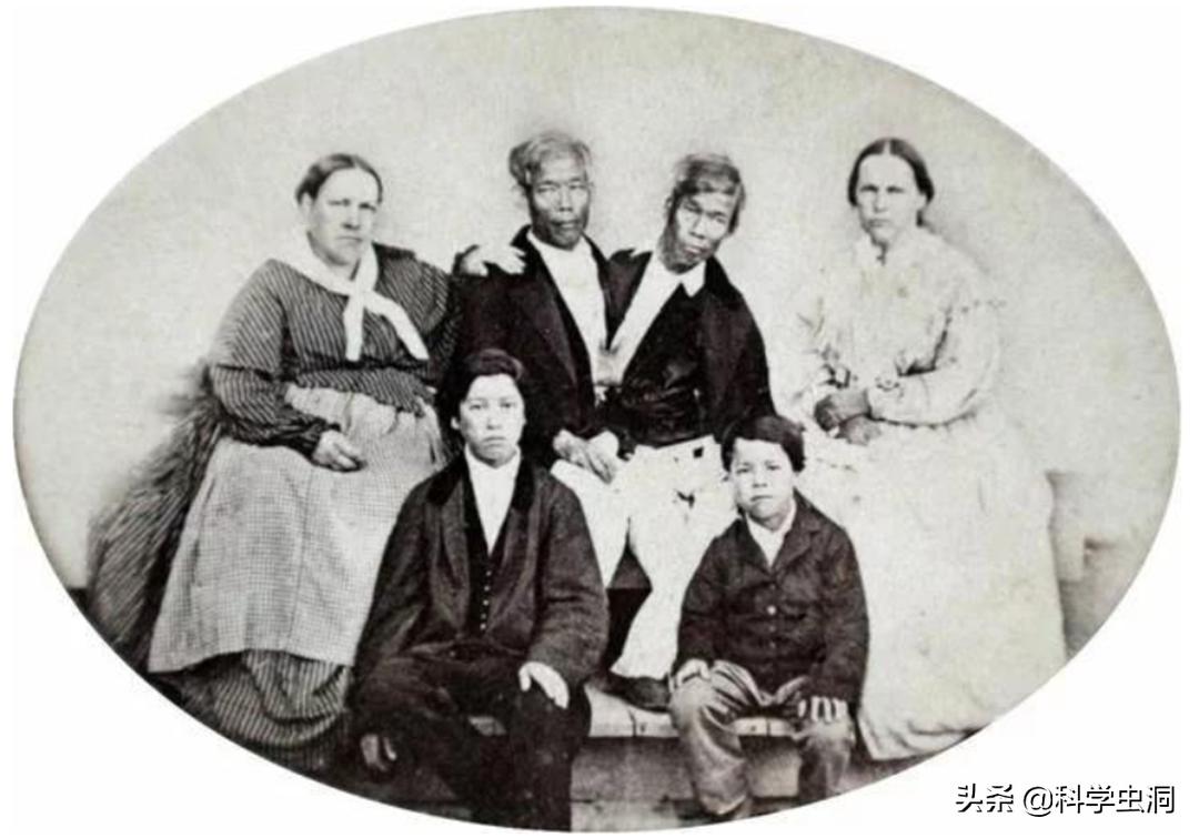 连体姐妹其中一个人死了怎么办,连体姐妹一个死了另一个咋办