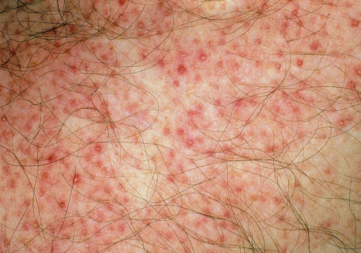 女士怎么确诊得了淋病,女生去医院检查有没有得淋病