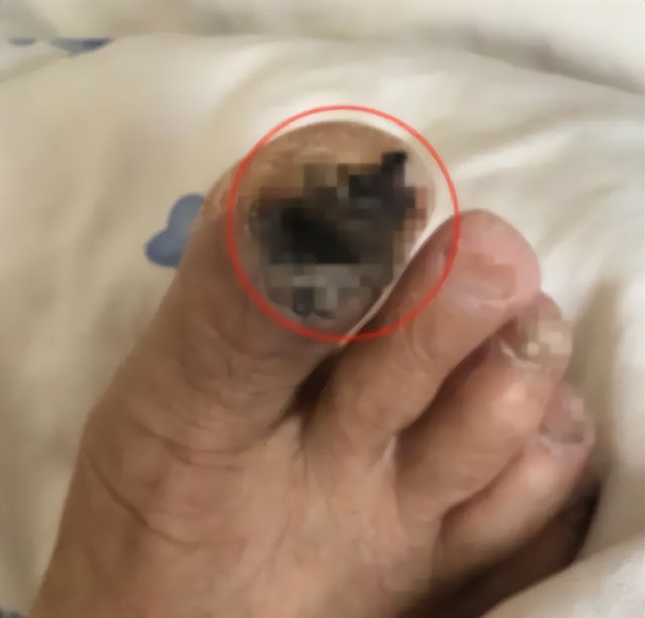 指甲出现斑块都是癌吗,指甲上有征兆或是甲状腺出了问题