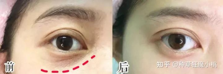 遗传的黑眼圈怎么去掉,如何去掉黑眼圈学生党