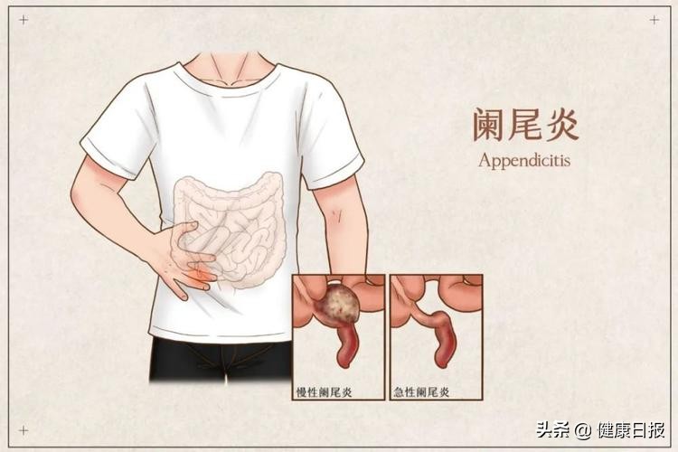 阑尾炎为什么要切掉阑尾,阑尾炎可以不割掉阑尾么