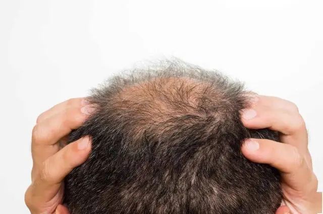 拿什么拯救你我的秀发,拿什么拯救我的秃顶