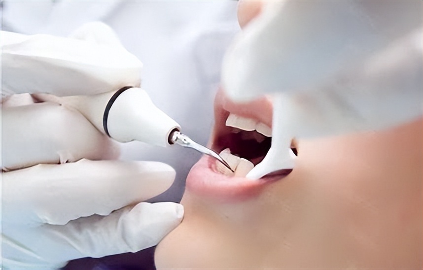 牙缝间牙结石怎样清除干净,牙缝表面的牙结石怎么洗掉